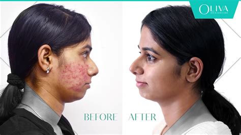 Laser Treatment For Acne Scars Cost In Bangalore Change Comin