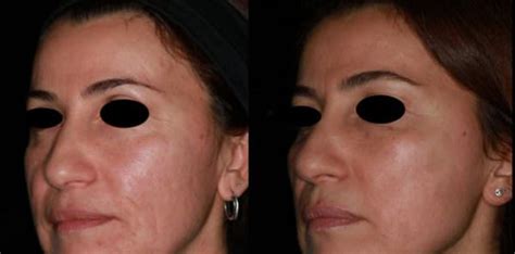 Rimozione Cicatrici Acne Laserplast