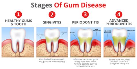 Learn About Gum Disease Gum Infection Stages Periodontitis Treatment