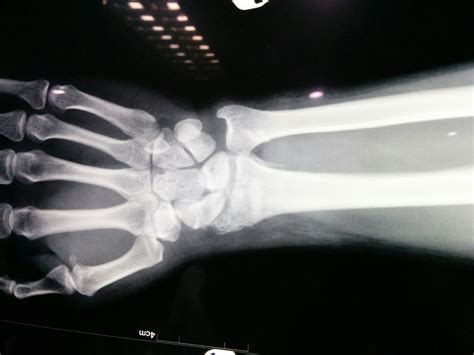 Bartons Fracture Prof Nay Win
