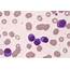 Plasma Cell Leukemia  2