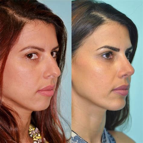 Chin And Facial Implant Rhinoplasty Photos Chevy Chase Md Patient 12273