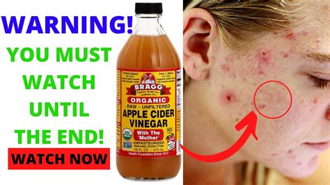 How To Use Apple Cider Vinegar For Acne How To Cure Acne Acne Marks