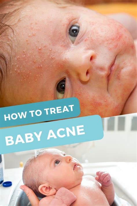Baby Acne Treatment And Help Baby Acne Baby Acne Treatment