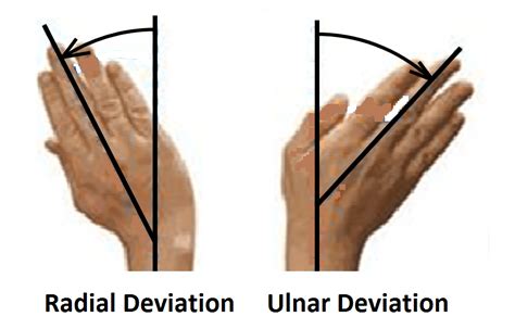 Ulnar Deviation X Ray