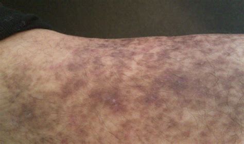 I Have Purple Spots On My Lower Legs That I Have Been Told