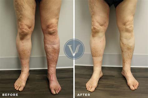 Treatment For Dvt And Varicose Veins The Vein Institute At Ssa