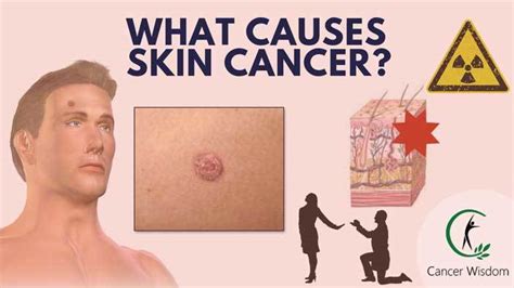 What Causes Skin Cancer Find Out The Truth Now Cancer Wisdom