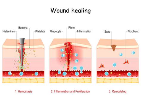 Phases Of Wound Healing Pic Illustrations Royalty Free Vector Graphics