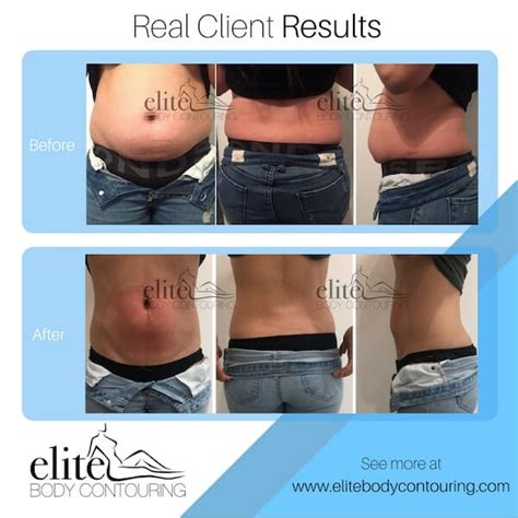 Elite Body Contouring Sydney S Rated Body Contouring Clinic