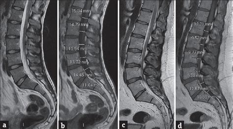 Sagittal Normal Limits Of Lumbosacral Spine In A Large Adult Population