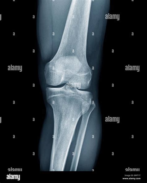 Normal Knee X Ray Stock Photos And Normal Knee X Ray Stock Images Alamy
