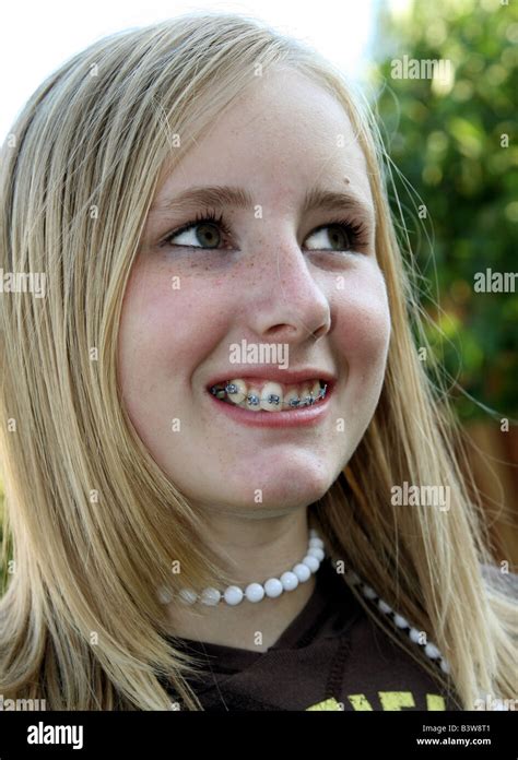 Year Old Girl Braces Hi Res Stock Photography And Images Alamy