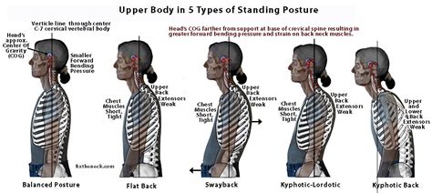 Overcoming Chronic Neck Pain Postural Causes And A Unique Exercise Fix