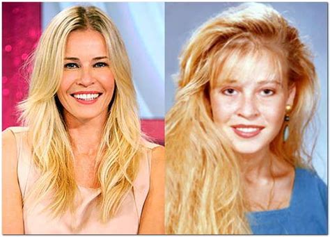 Chelsea Handler Plastic Surgery Before After Plastic Surgery Cosmetic Surgery Chelsea Handler