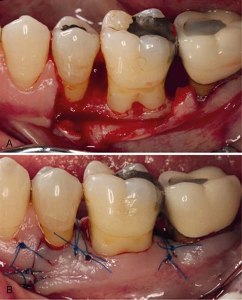 Chronic Periodontitis Pocket Dentistry