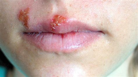 Should You Pop A Water Blister On Lip Balm