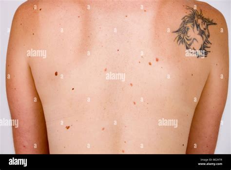 Moles On The Back Skin Cancer Risk Stock Photo 25875047 Alamy