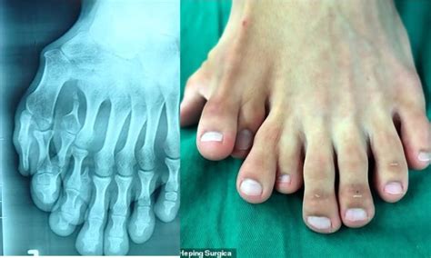 Meet Chinese Man Born With Nine Toes And How He Sought Help To Cut Off Four Of Them Expressive