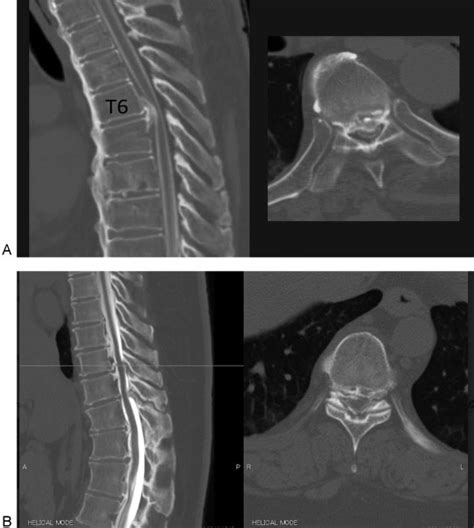 A Sagittal And Axial Computed Tomography Ct Of The Thoracic Spine