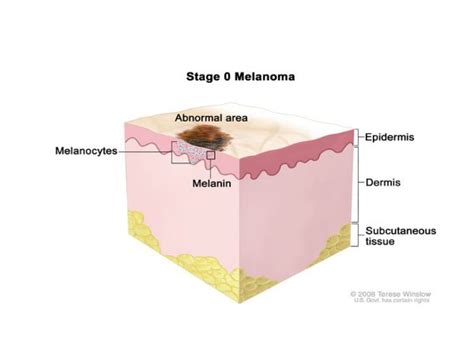 The Complete Guide To Melanoma Symptoms Causes And Cure
