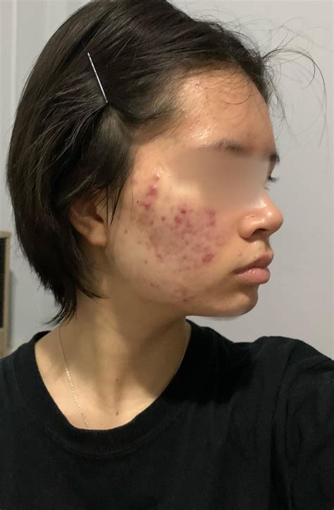 Acne Acne Scar Progress Rskincareaddiction