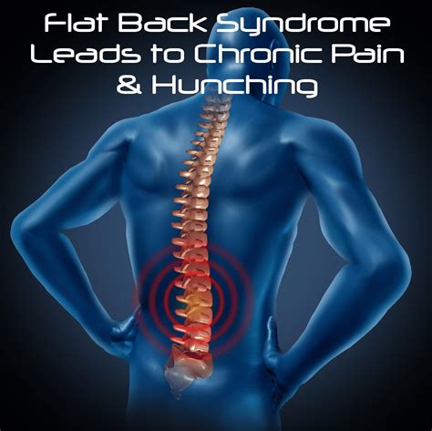 The Drs Flat Back Syndrome Causes Chronic Pain And Corrective Surgery