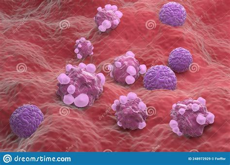Ovarian Cancer Cells In The Female Ovum Isometric View 3d