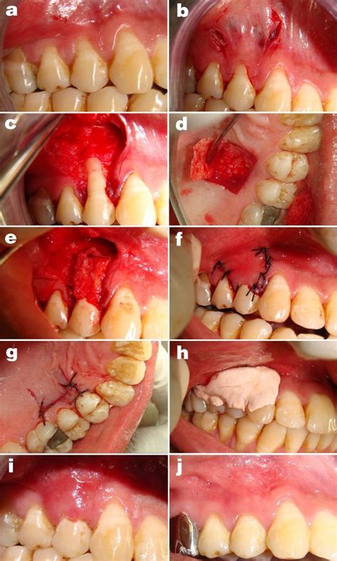 Treatment involves making an incision around the tooth, relaxing the tissue then inserting new tissue under the recessed tissue. Subepithelial connective tissue graft (Group A). a. Pre ...