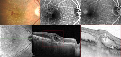 Clinical Relevance Of The Anatomic Classification Of Neovascular Age