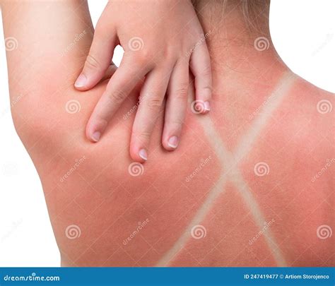 Sunburn Girl Got A Sunburn Red Painful Skin On Back That Feels Hot To