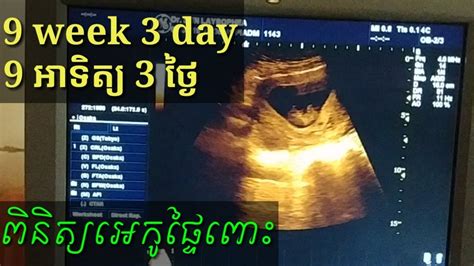 ពិនិត្យអេកូផ្ទៃពោះ 9 អាទិត្យ Pregnancy Ultrasound 9 Week By Drbun