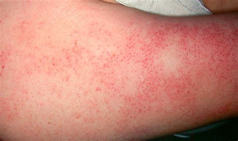 6 Causes And Treatment Of Big Red Spots On Skin Skincarederm