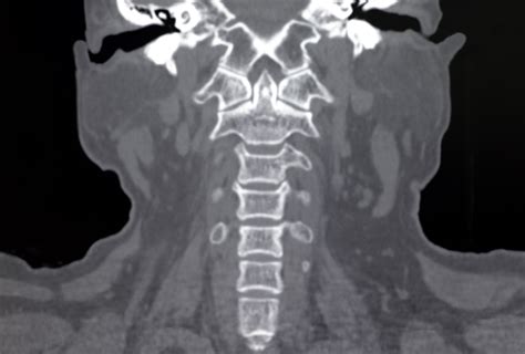 No Benefit For Mri After Normal Cervical Ct In Blunt Trauma Neurology