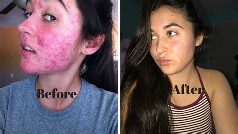 My Accutane Journey Cycstic To Clear Skin Youtube
