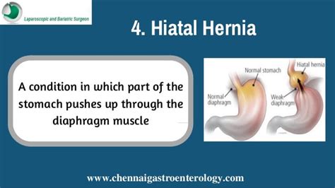 Laparoscopic Hernia Treatment In Chennai Keyhole Hernia Surgery In India