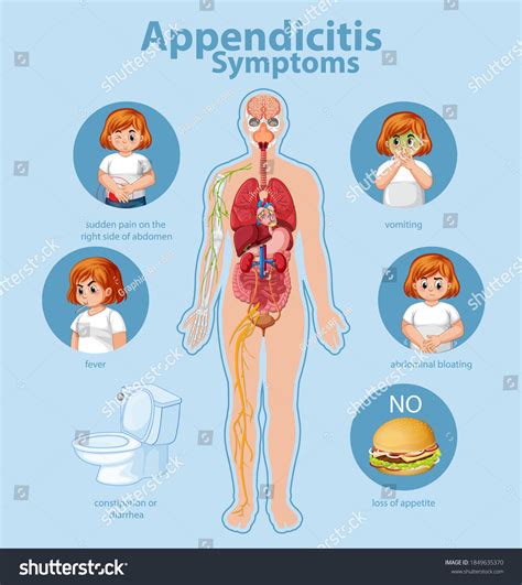 Appendicitis Symptoms Information Infographic Illustration เวกเตอร์
