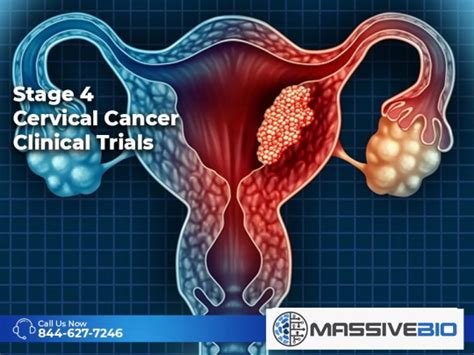 Stage 4 Cervical Cancer Clinical Trials Massive Bio