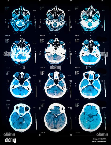 Sequence Of Horizontal Sections Of A Female Human Brain Mri Scans Magnetic Resonance Imaging