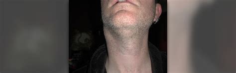 Swollen Glands Under Jaw Lymphatic And Endocrine System Articles Body