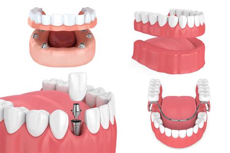 Dentures Vs Dental Implants Dental Health Associates Wolcott Ct