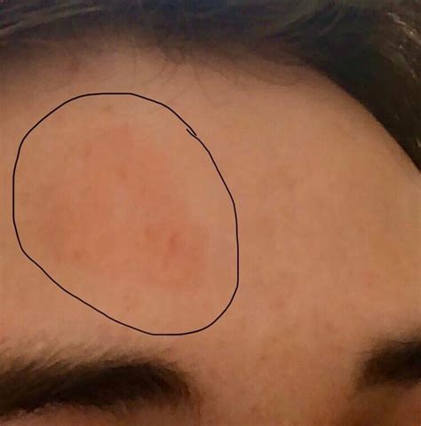 I Currently Have This Red Mark On My Forehead That I Got A While Ago
