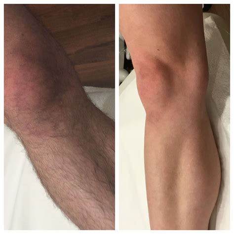 Laser Hair Removal Legs Before And After