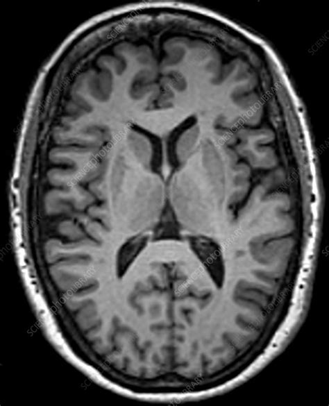Normal Brain Mri Stock Image C Science Photo Library