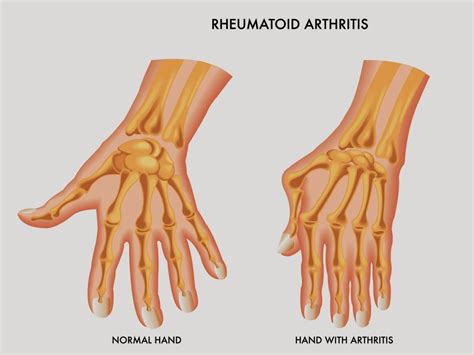 Most Common Signs And Symptoms Of Early Onset Arthritis Churchill