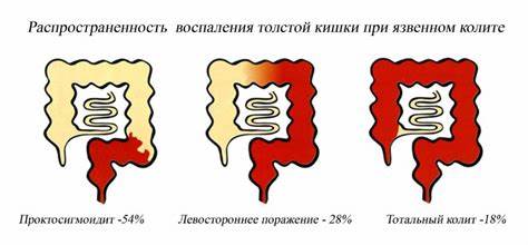 Диета язвенного колита кишечника Язвенный колит (ЯК) - причины, признаки, лечение Язвенный колит (ЯК) - причины, признаки, лечение Диета язвенного колита кишечника