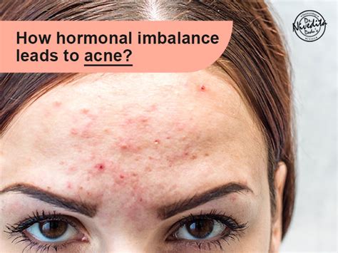 Hormonal Acne Causes And Treatment