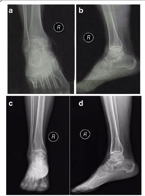 The Typical Radiographic Views Of The Ankle Before And After