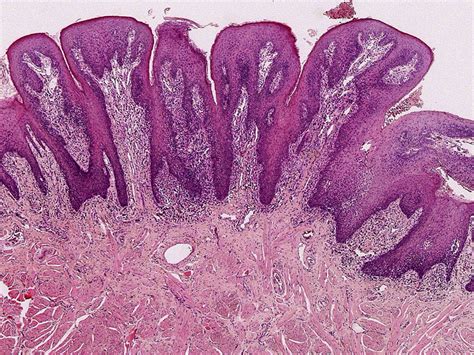 Papillary And Verrucous Lesions Of The Oral Mucosa Diagnostic Histopathology