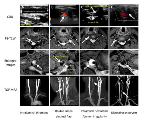 Figure Characteristics Of The Extracranial Vertebral Artery Dissection Download Scientific